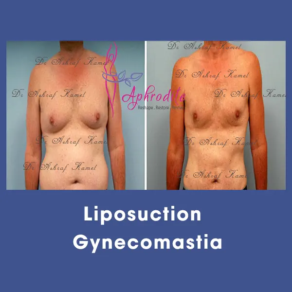 التثدي بالفيزر (مخدر موضعي)