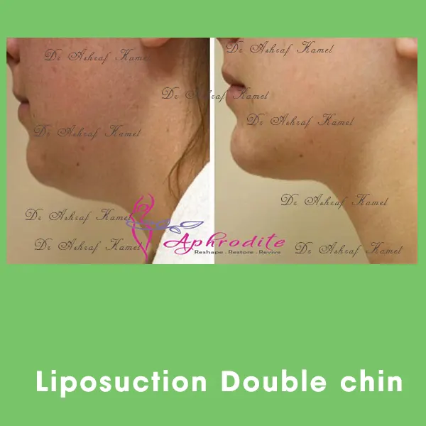 تحديد الفك واللغد