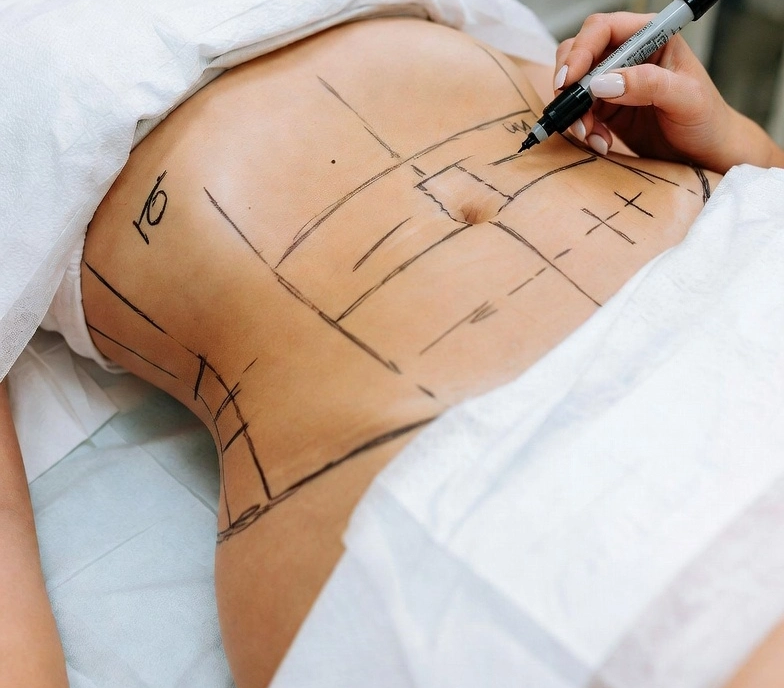 شفط الدهون الذاتية